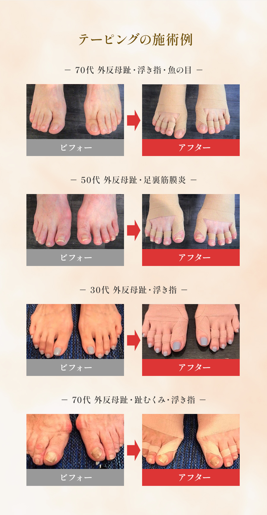 テーピングの施術例